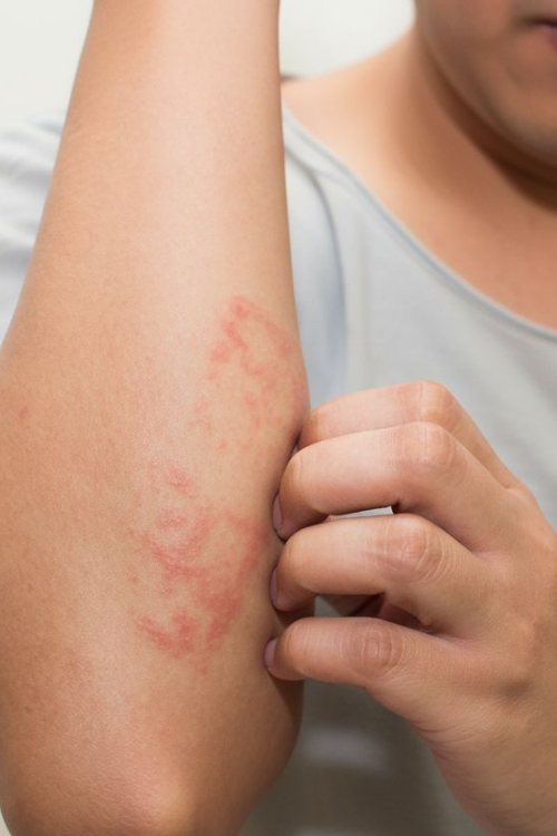 Dermatitis atópica eccema